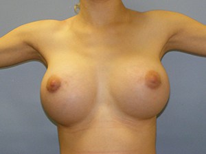 Breast Augmentation before and after - after