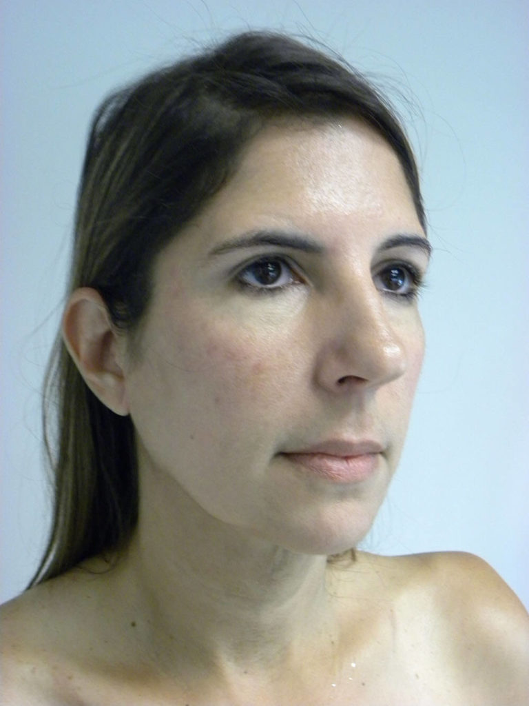 Chin before and after - after