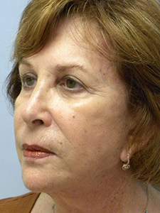 Facelift before and after - after
