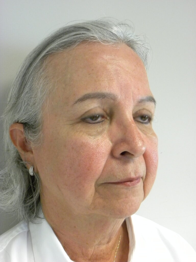 Blepharoplasty before and after - after