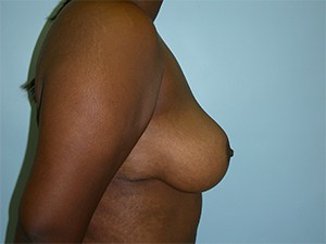 Breast Reduction before and after - after