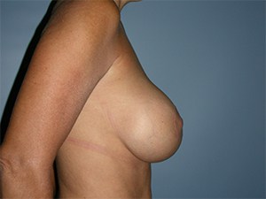 Breast Augmentation before and after - after