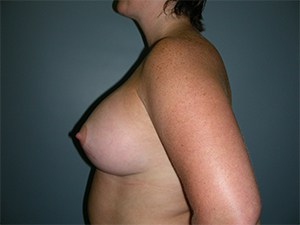 Breast Augmentation before and after - after