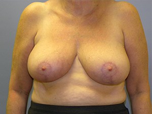 Breast Reduction before and after - after