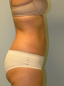 Liposuction before and after - after