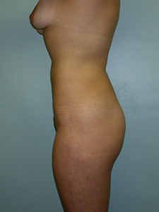 Liposuction before and after - after
