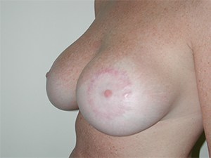 Breast Lift before and after - after