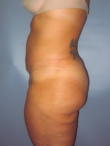 Liposuction before and after - after
