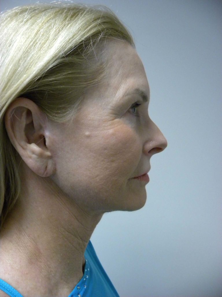 Facelift before and after - after