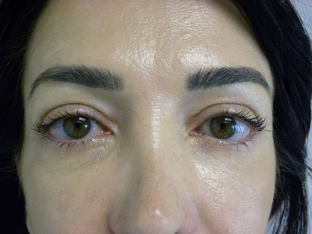 Blepharoplasty before and after - after