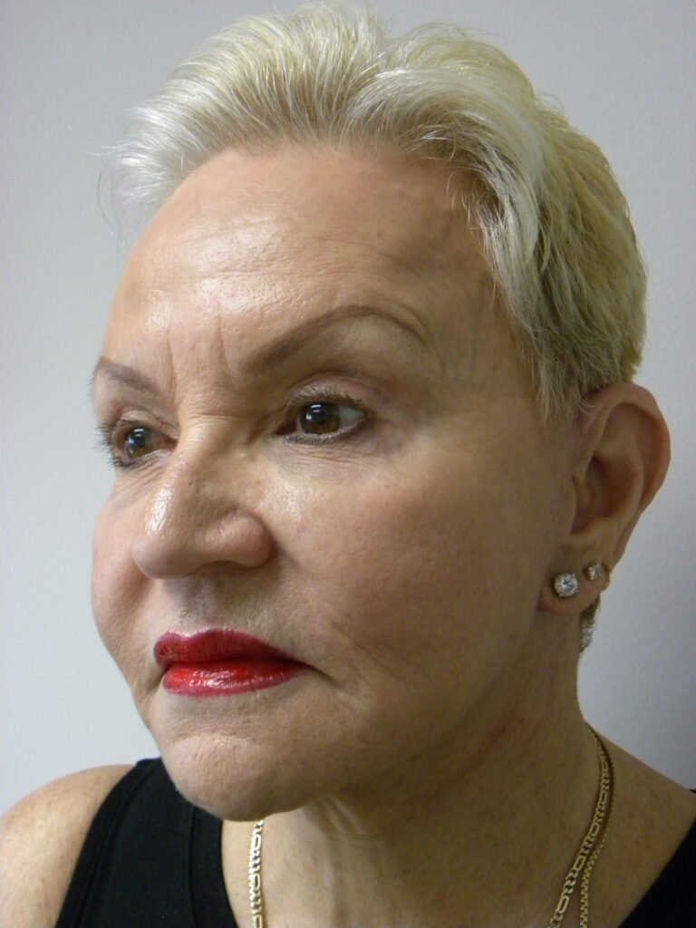 Facelift before and after - after