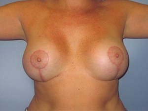 Breast Augmentation before and after - after