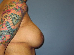 Breast Lift before and after - after