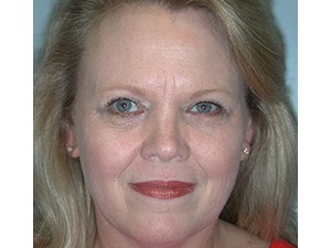 Blepharoplasty before and after - after