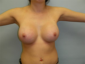 Breast Augmentation before and after - after