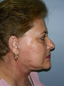 Facelift before and after - after