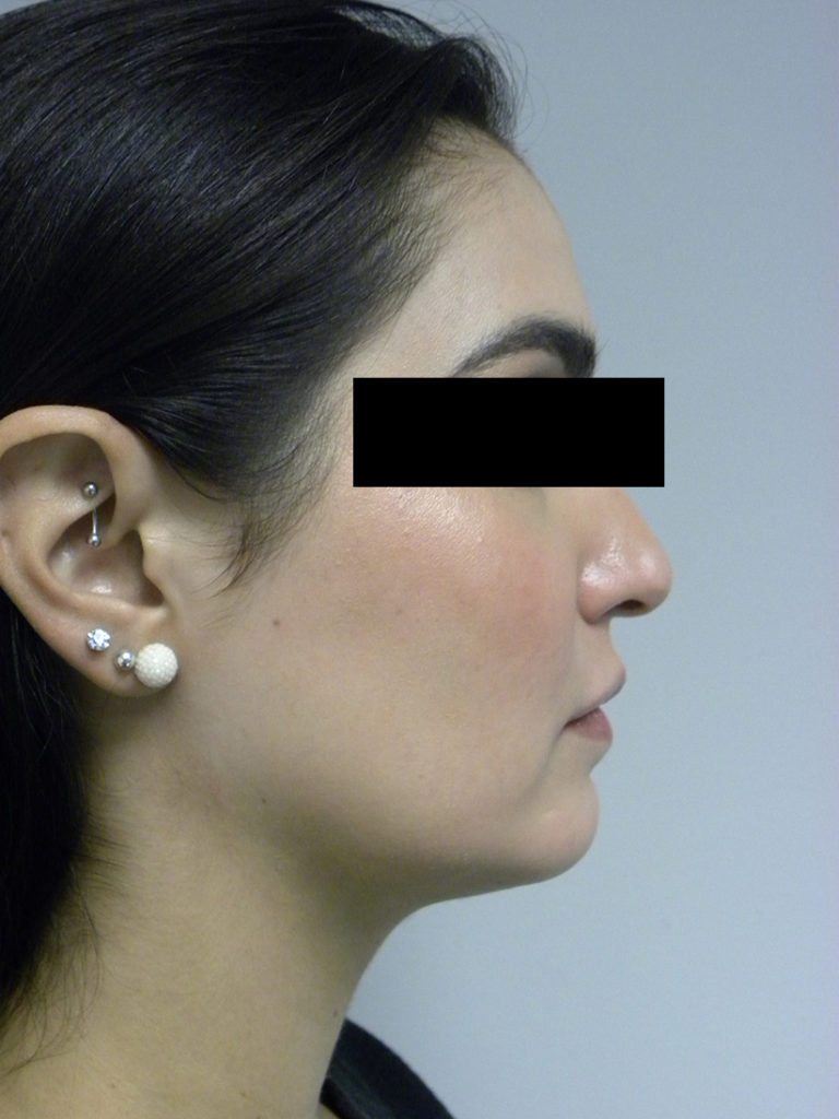 Chin before and after - after