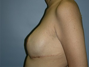 Breast Augmentation before and after - after
