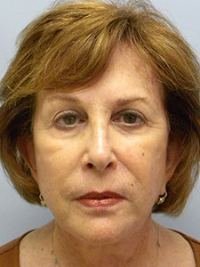 Facelift before and after - after