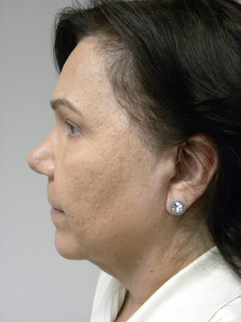 Blepharoplasty before and after - after