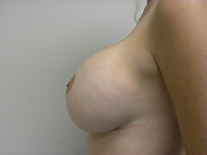 Breast Augmentation before and after - after