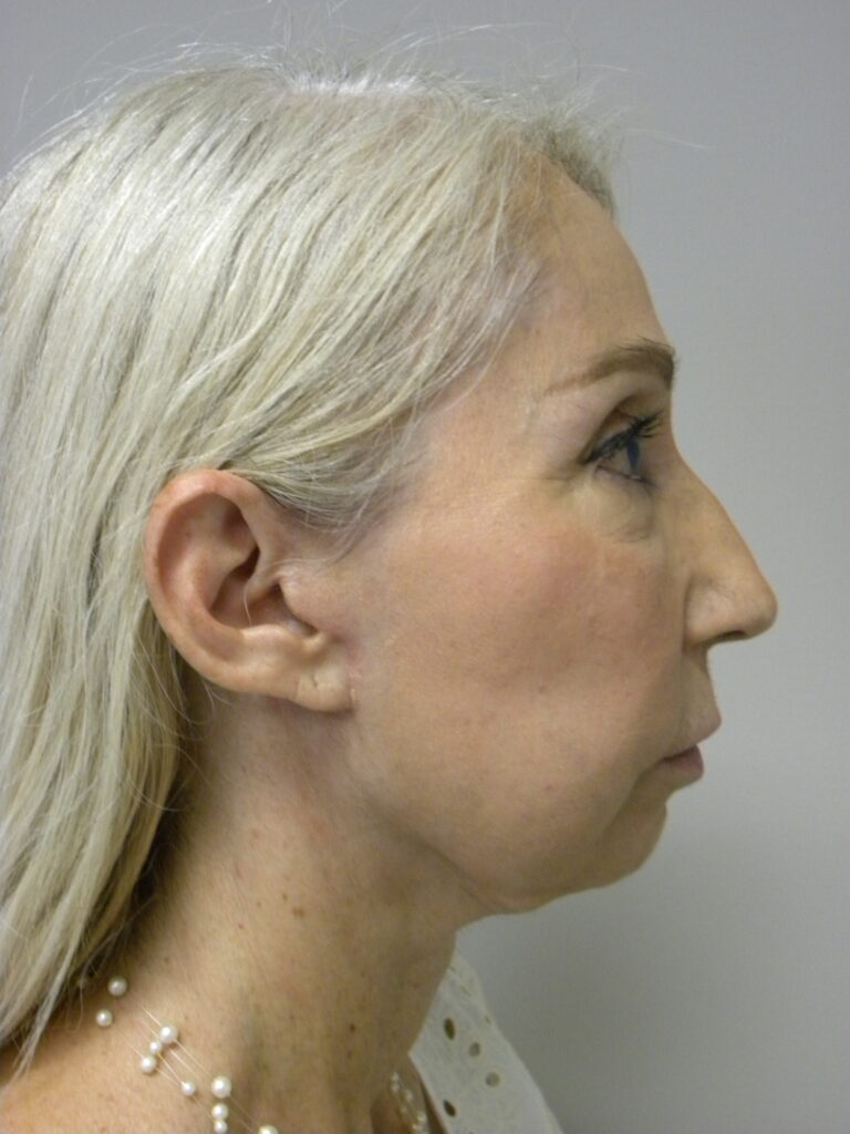 Facelift before and after - after