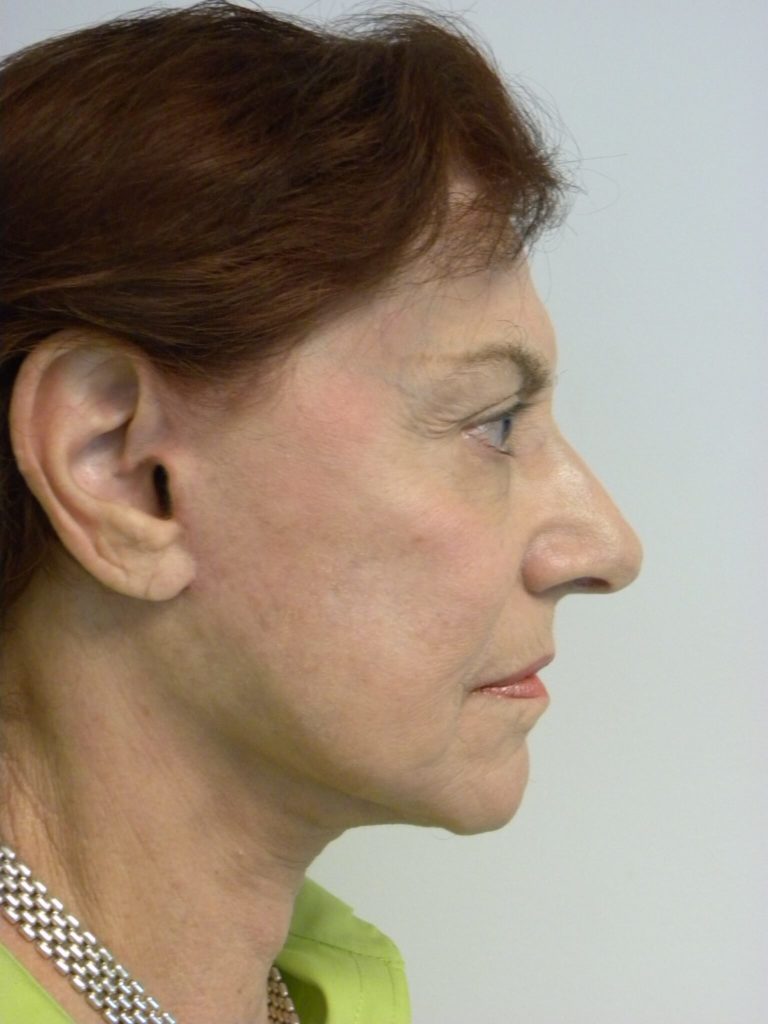 Facelift before and after - after