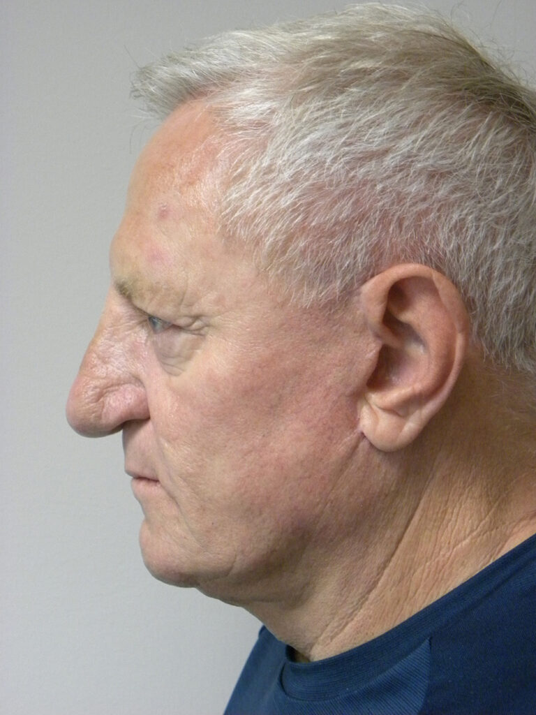 Facelift before and after - after