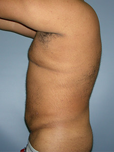 Liposuction before and after - after