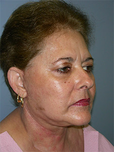 Facelift before and after - after