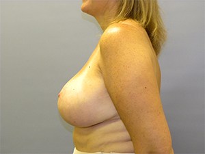 Breast Reduction before and after - after