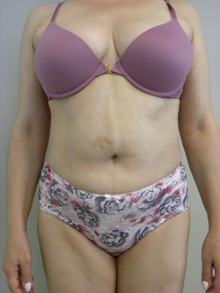 Liposuction before and after - after
