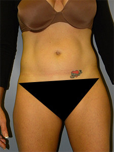 Liposuction before and after - after