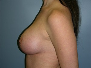 Breast Augmentation before and after - after