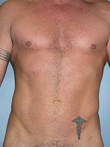 Liposuction before and after - after