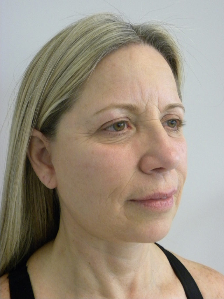 Facelift before and after - after