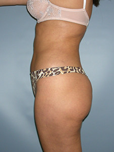 Liposuction before and after - after