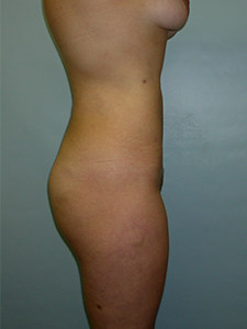 Liposuction before and after - after