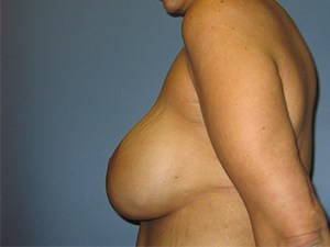 Breast Lift before and after - after