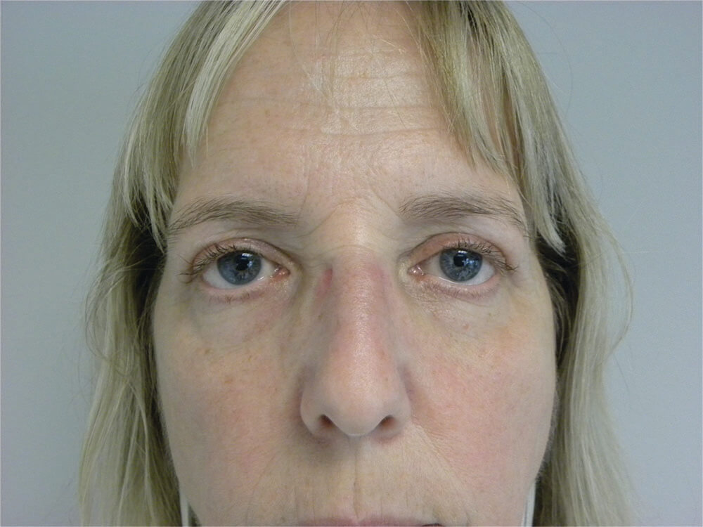 Blepharoplasty before and after - after