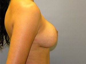 Breast Augmentation before and after - after