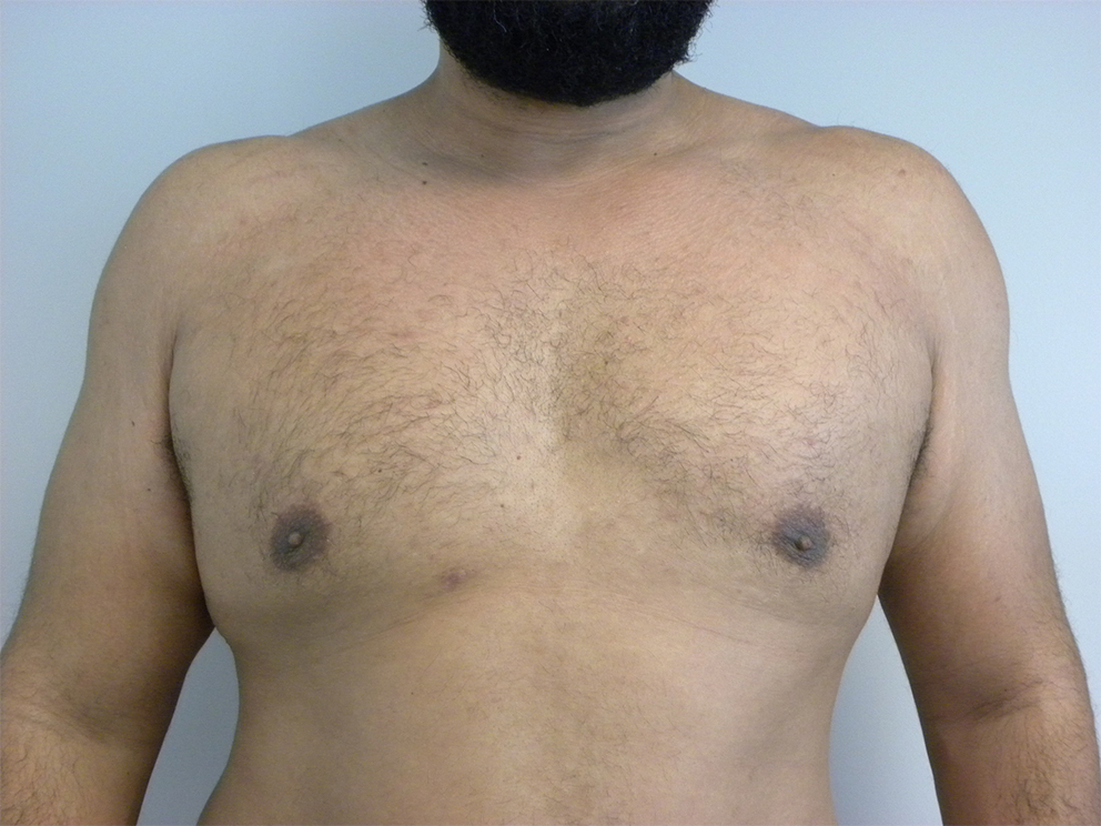 Liposuction before and after - after