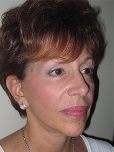 Facelift before and after - after