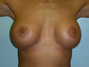 Breast Augmentation before and after - after