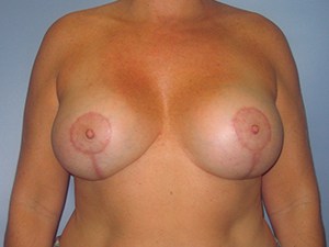 Breast Augmentation before and after - after
