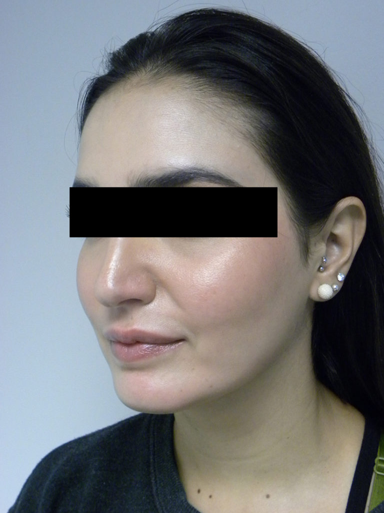 Chin before and after - after