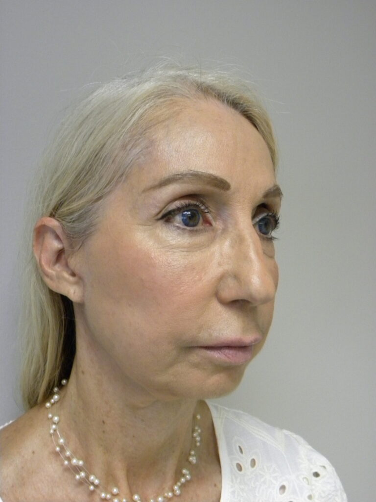 Facelift before and after - after