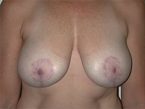 Breast Lift before and after - after