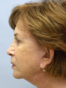 Facelift before and after - after