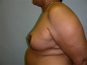 Breast Reduction before and after - after